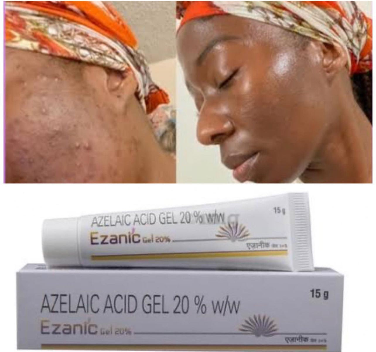 Azelaic acid gel Acne Treatment Gel,Redness Relief, Balance Excess sunburn, Ease Pimple and Clarify Skin,Azelaic Acid gel