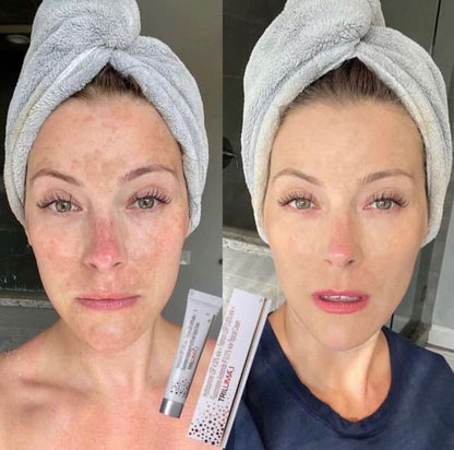 TriLuma hydroquinone + tretinoin Cream for Dark Spots on Face  – Age Spot, Sun Spot, and Melasma